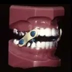 This image shows a 3D digital model of teeth , likely used in orthodontics or dental treatment planning.