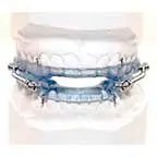 This image shows a functional orthodontic appliance , likely used for treating snoring or sleep apnea.