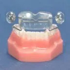 This image shows a functional orthodontic appliance , likely used for treating snoring or sleep apnea.