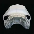 This image shows a functional orthodontic appliance , likely used for treating snoring or sleep apnea.