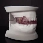 This image shows a functional orthodontic appliance , likely used for treating snoring or sleep apnea.