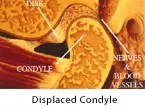 Displaced Condyle
