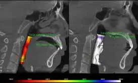 This image shows a 3D medical visualization of the upper airway, likely used for assessing conditions such as sleep apnea or airway obstruction. 
