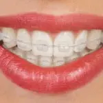 A close-up image of a person's mouth with invisible braces.