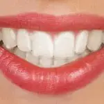A close-up image of a person's mouth with clear aligners.