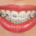 A close-up image of a person's mouth with braces.