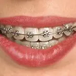A close-up image of a person's mouth with braces.